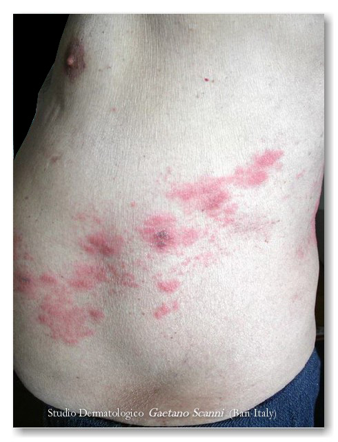 varicella rash #10