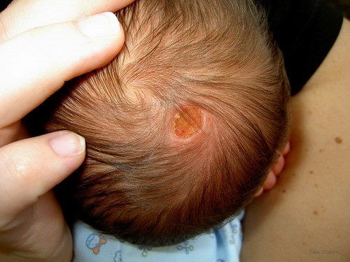 Dermatite Seborroica nel neonato e bambini