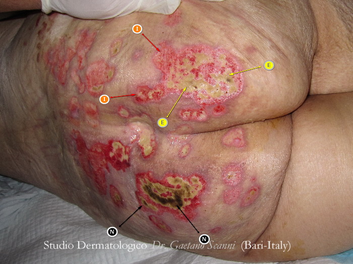 Ulcere da Decubito - Dr. Gaetano Scanni